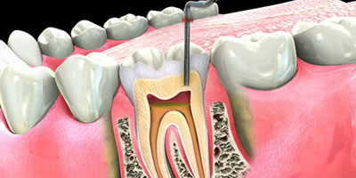 Tand ondt rodbehandlet gør Rodbetændelse og